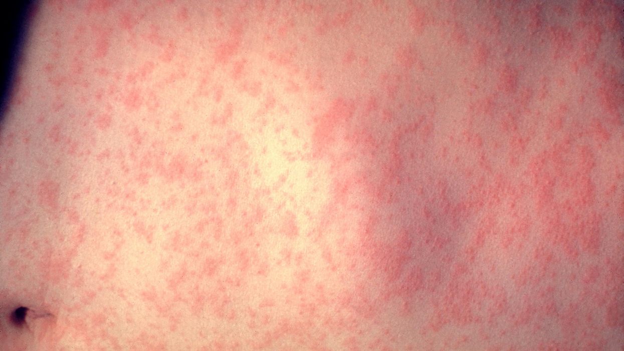 The Truth About Measles